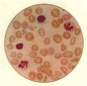 营养性大细胞必贫血血象(1)