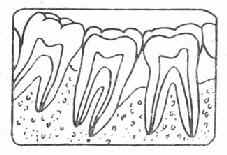 牙槽骨Ⅱ吸收