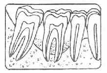 牙槽骨Ⅲ吸收