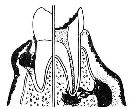 牙周脓肿与牙槽脓肿的鉴别