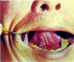 舌下囊肿(左)
