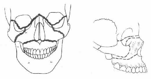 上颌骨骨折三种类型