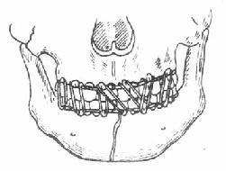 颌间牵引固定法