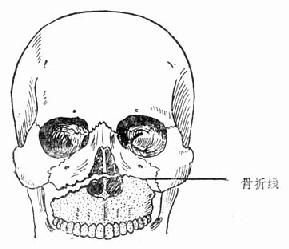 上颌骨骨折Ⅰ型