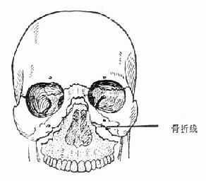 上颌骨折骨Ⅱ型