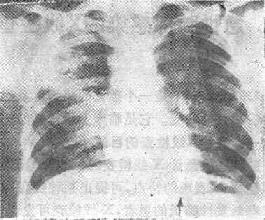 右肺化脓性肺炎之X线表现